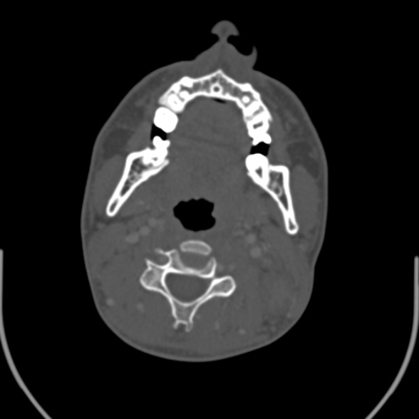 Nasopharyngeal carcinoma with skull base invasion (Radiopaedia 53415-59705 Axial bone window 99).jpg