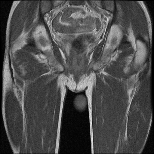 File:Necrotizing epididymo-orchitis with intra-testicular abscess (Radiopaedia 29397-29860 Coronal T1 C+ 18).jpg