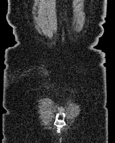 File:Nephrostomy for urosepsis (Radiopaedia 26180-26330 non-contrast 84).jpg
