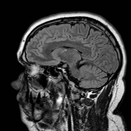 File:Neuro-Behcet's disease (Radiopaedia 21557-21506 Sagittal FLAIR 14).jpg