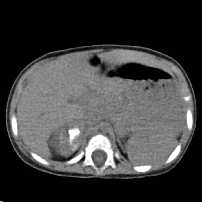 Neuroblastoma with skull metastases (Radiopaedia 30326-30960 Axial non-contrast 17).jpg