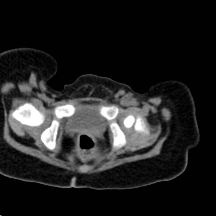 Neuroblastoma with skull metastases (Radiopaedia 30326-30960 Axial non-contrast 60).jpg