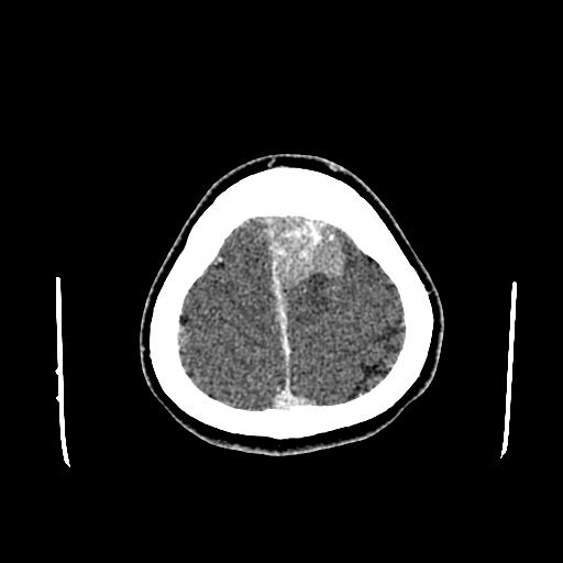File:Neurofibromatosis type 2 (Radiopaedia 25389-25637 Axial C+ 90).jpg