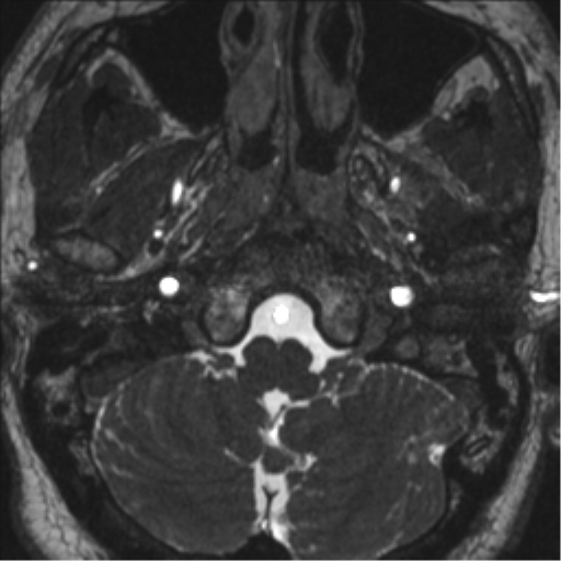 Neurofibromatosis type 2 (Radiopaedia 44936-48838 E 10).png