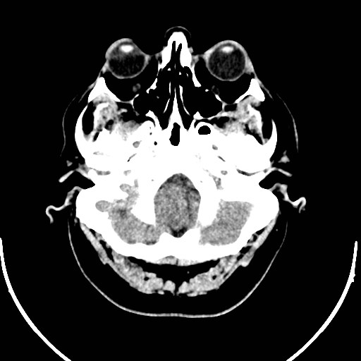 Neurofibromatosis type 2 (Radiopaedia 79097-92047 Axial non-contrast 8).jpg