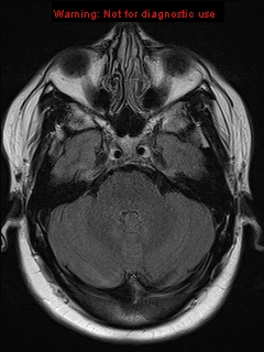 File:Neuroglial cyst (Radiopaedia 10713-11184 Axial FLAIR 17).jpg