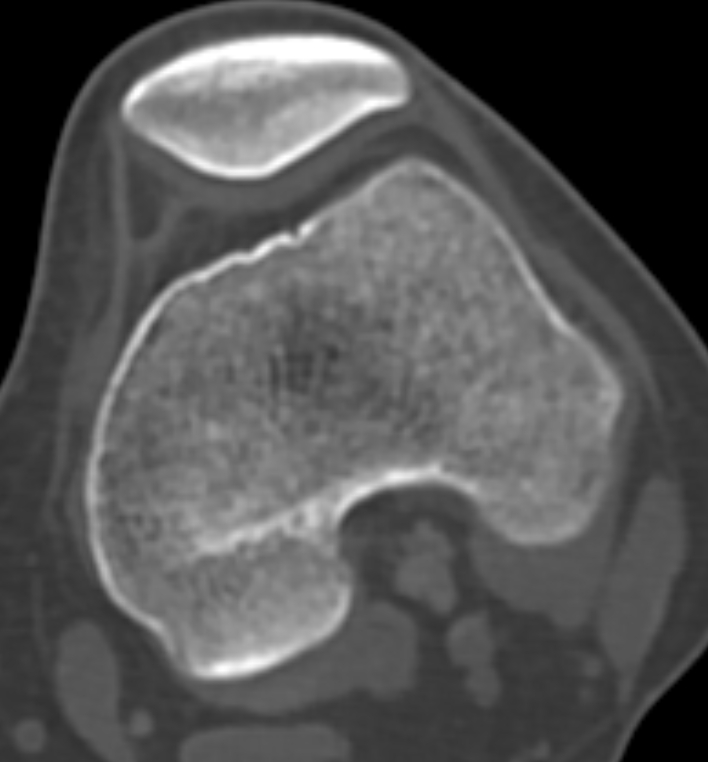 Non-ossifying fibroma - femur (Radiopaedia 82786-97042 Axial bone window 50).jpg