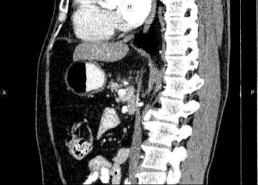 Non-syndromic pancreatic endocrine tumor (Radiopaedia 86958-103178 E 51).jpg