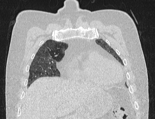 Non specific interstitial pneumonia (NSIP) (Radiopaedia 89725-106798 Coronal lung window 21).jpg