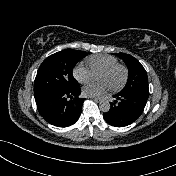 Normal CT chest- adult female (Radiopaedia 52522-58428 Axial non-contrast 76).jpg