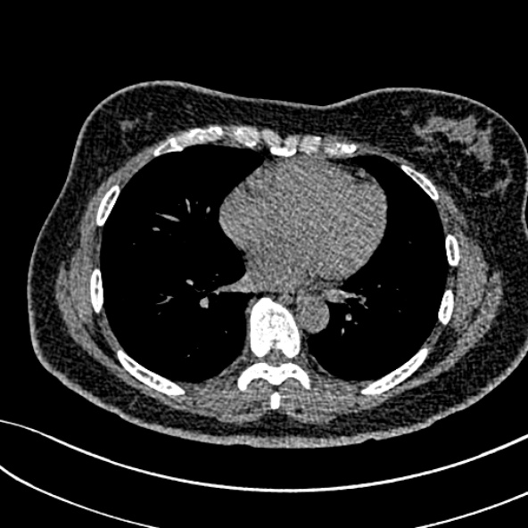 Normal CT chest- adult female (Radiopaedia 52522-58428 Axial non-contrast 79).jpg