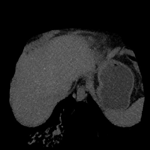 File:Normal CT intravenous cholangiogram (Radiopaedia 38199-40208 Axial IVC (MIP) 82).png