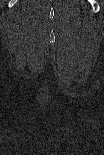 Normal CT lumbar spine (Radiopaedia 53981-60118 Coronal bone window 76).jpg