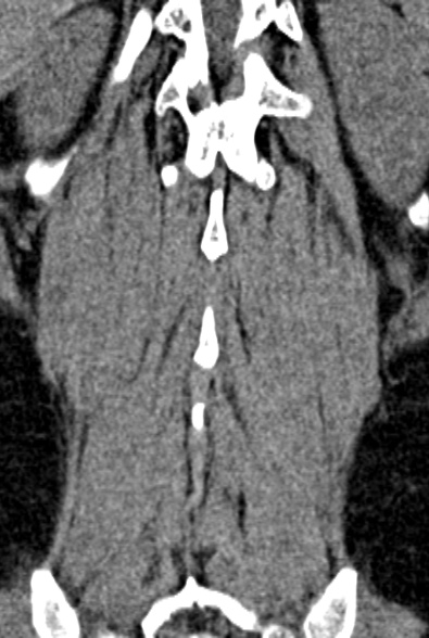 Normal CT lumbar spine (Radiopaedia 53981-60118 F 84).jpg