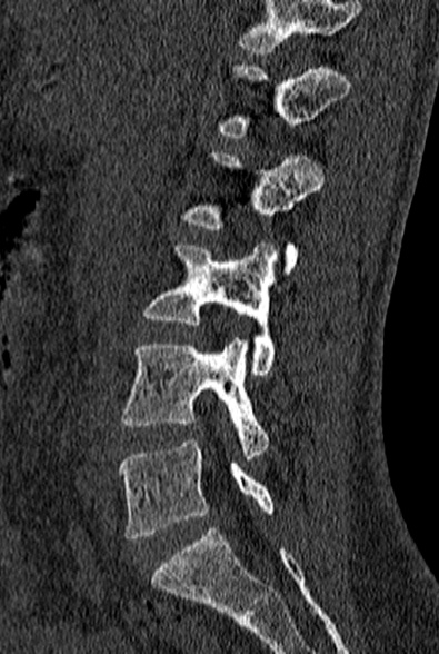 File:Normal CT lumbar spine (Radiopaedia 53981-60118 Sagittal bone window 36).jpg