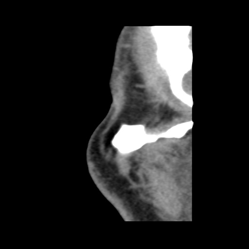Normal CT paranasal sinuses (Radiopaedia 42286-45390 F 136).jpg