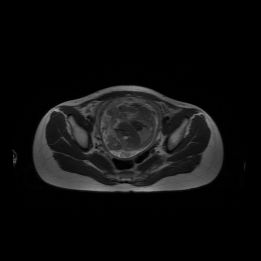 File:Normal MRI abdomen in pregnancy (Radiopaedia 88001-104541 Axial T2 59).jpg