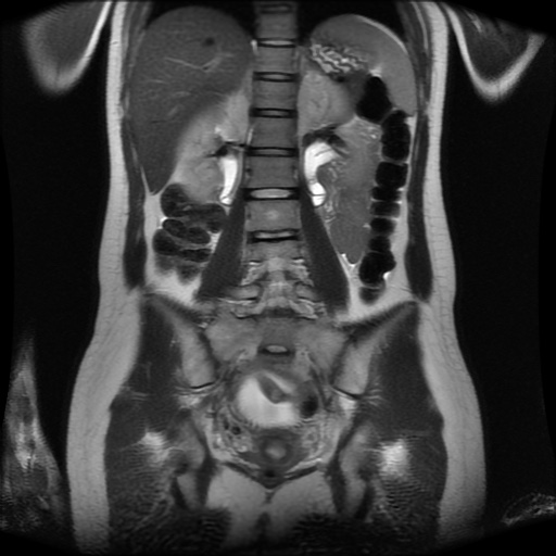 File:Normal MRI abdomen in pregnancy (Radiopaedia 88001-104541 Coronal T2 21).jpg