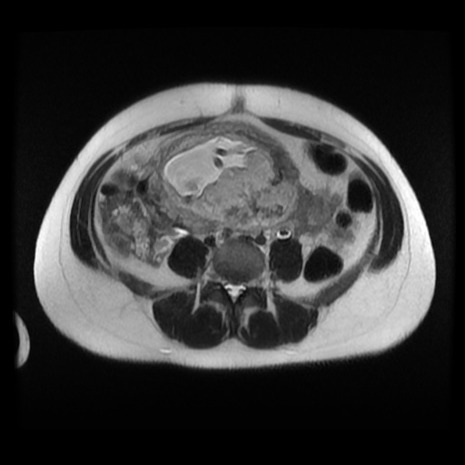 Normal MRI abdomen in pregnancy (Radiopaedia 88003-104546 Axial T2 25).jpg