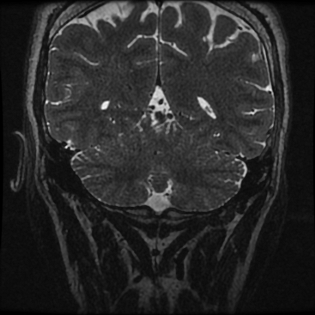 Normal MRI petrous (Radiopaedia 91317-108949 Coronal T2 113).jpg