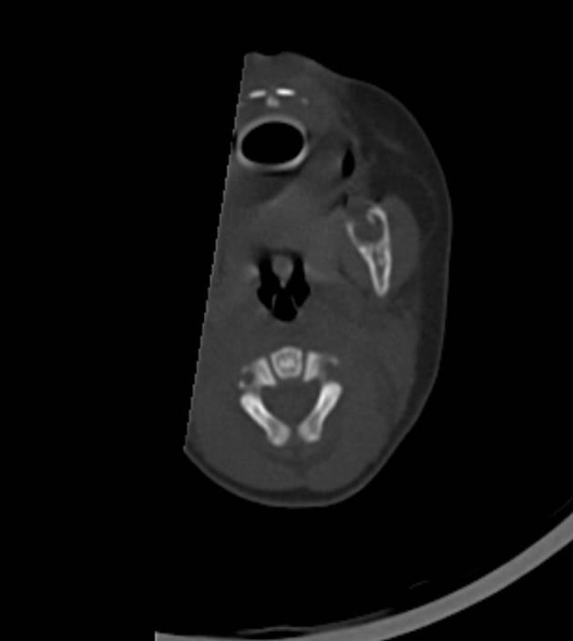 Normal brain CT - 2-month-old (Radiopaedia 53369-59350 Axial bone window 62).jpg
