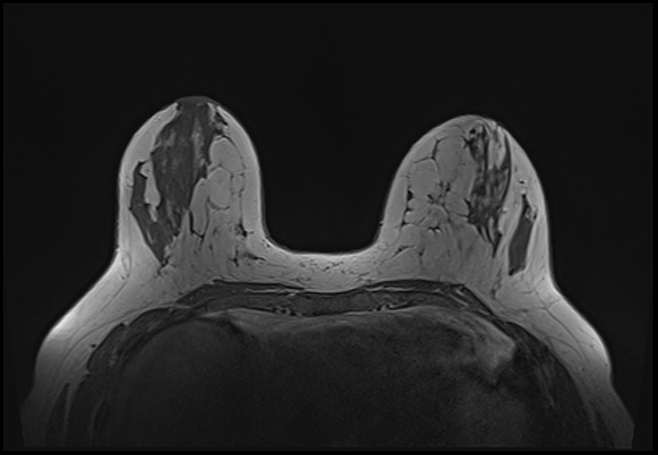 File:Normal breast MRI - dense breasts (Radiopaedia 80454-93850 Axial T1 77).jpg