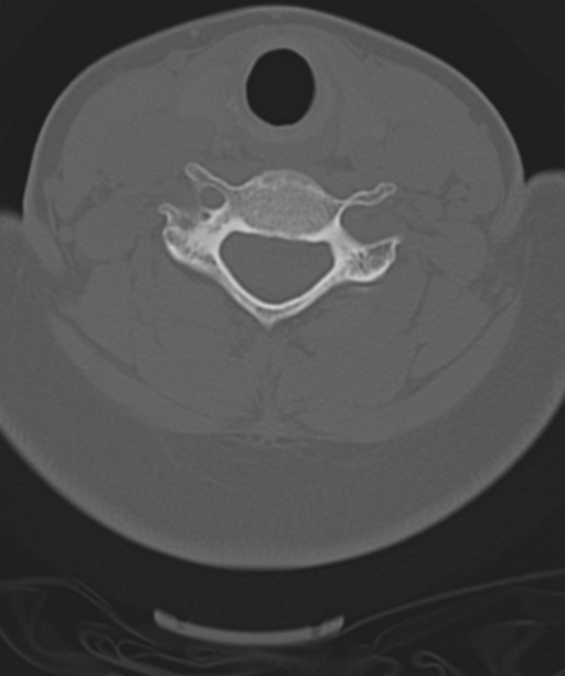 Normal cervical spine MRI (including Dixon) (Radiopaedia 42762-45926 Axial bone window 38).png