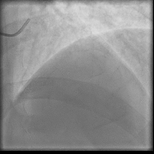 Normal coronary angiogram (DSA) (Radiopaedia 63081-71571 E 9).jpg