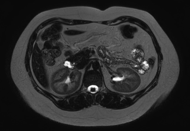 File:Normal liver MRI with Gadolinium (Radiopaedia 58913-66163 E 15).jpg
