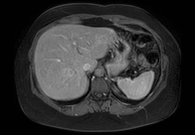 Normal liver MRI with Gadolinium (Radiopaedia 58913-66163 J 55).jpg