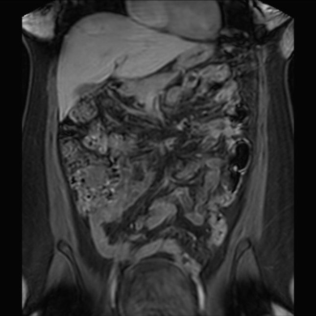Normal liver MRI with Gadolinium (Radiopaedia 58913-66163 P 34).jpg