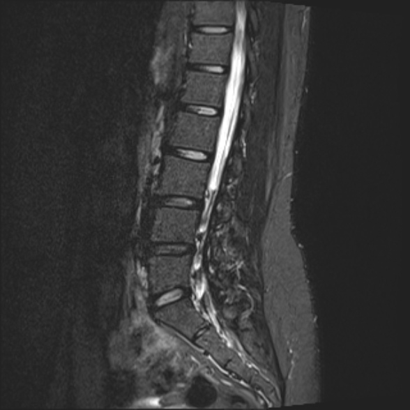 File:Normal lumbar spine MRI- 3 T (Radiopaedia 53280-59250 Sagittal STIR 11).jpg
