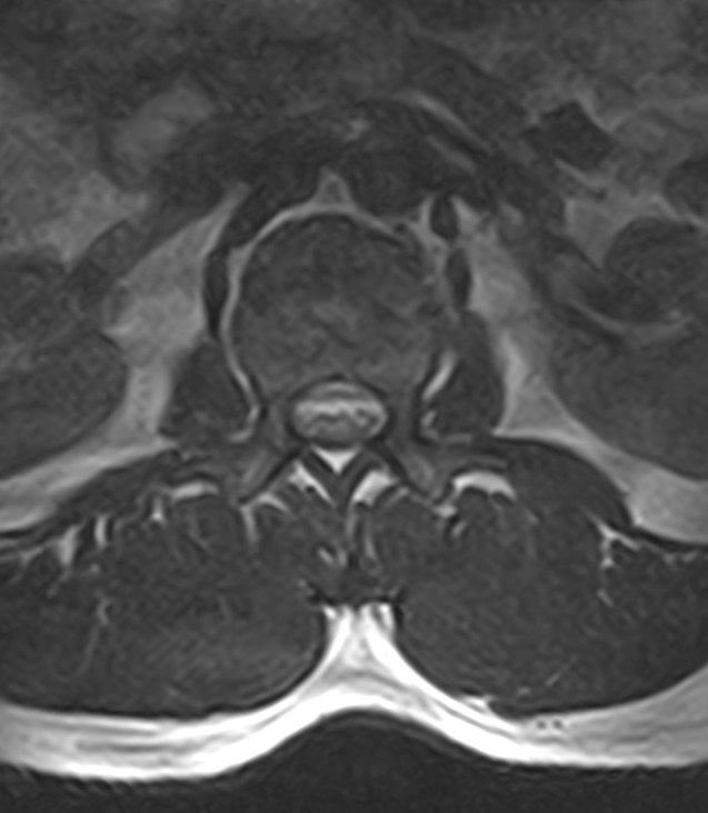 Normal lumbar spine MRI - low-field MRI scanner (Radiopaedia 40976-43699 Axial T2 24).jpg