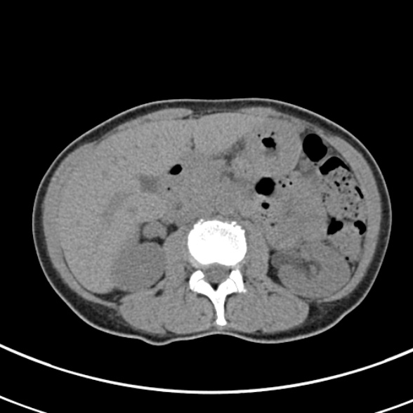 File:Normal multiphase CT liver (Radiopaedia 38026-39996 Axial non-contrast 31).jpg
