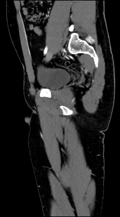 Normal pelvis CT angiogram (Radiopaedia 84966-100481 C 43).jpg