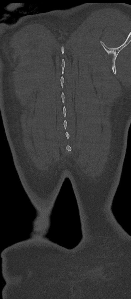 Normal thoracolumbar spine (Radiopaedia 43822-47309 Coronal bone window 89).png