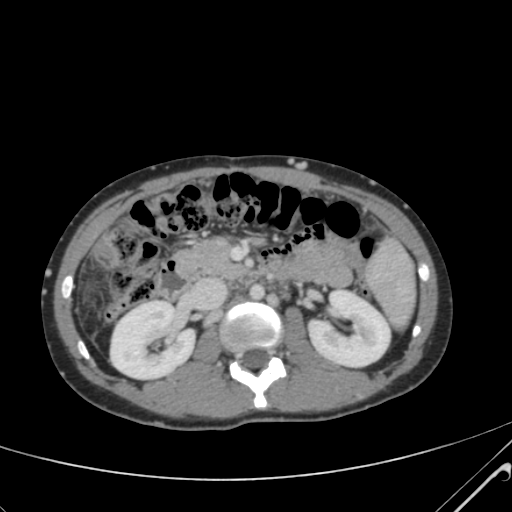 File:Nutmeg liver- Budd-Chiari syndrome (Radiopaedia 46234-50635 B 27).png