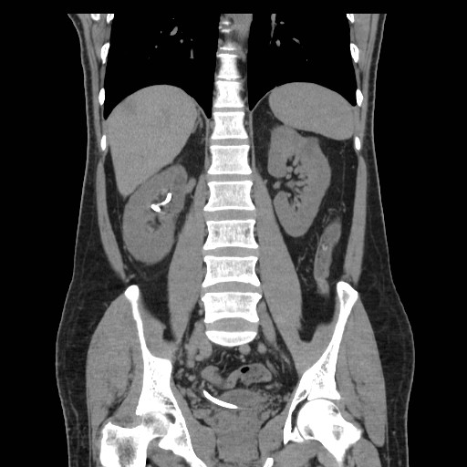 File:Obstructed kidney with perinephric urinoma (Radiopaedia 26889-27067 Coronal non-contrast 15).jpg