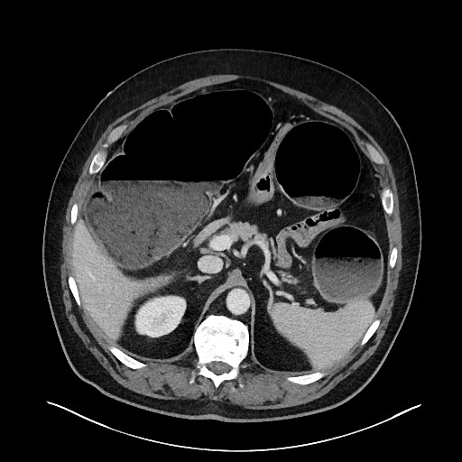 Obstructing sigmoid adenocarcinoma (Radiopaedia 58465-65619 A 49).jpg