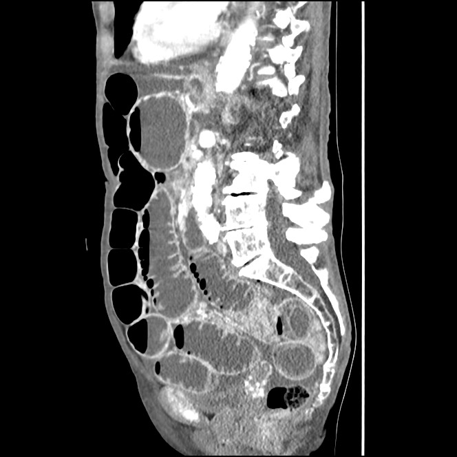 Obturator hernia causing small bowel obstruction (Radiopaedia 65522-74612 C 45).jpg