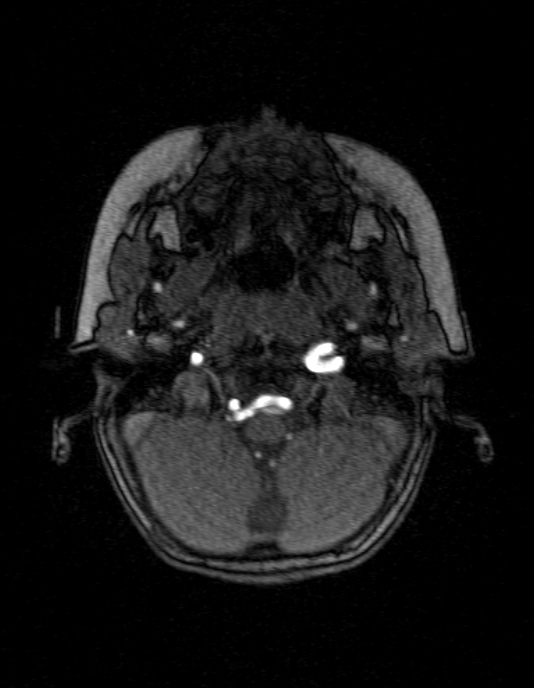 Occipital horn syndrome (Radiopaedia 14255-14129 MRA 21).jpg