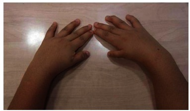 Bilateral thumb hypoplasia in person affected by Okihiro syndrome.