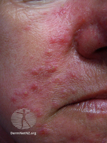 Rosacea (DermNet NZ acne-red-face-3622).jpg