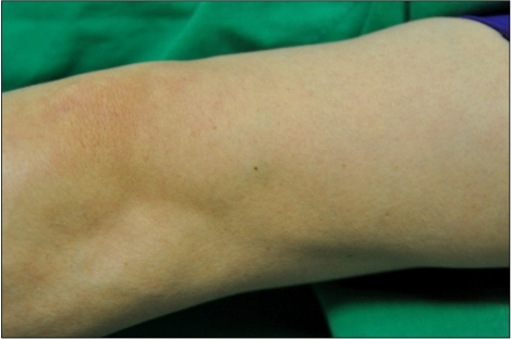 File:Sinusoidal hemangioma arm.png