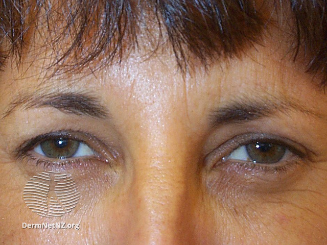 File:Subject attempting to frown after botulinum toxin injections (DermNet NZ procedures-botox-effect).jpg