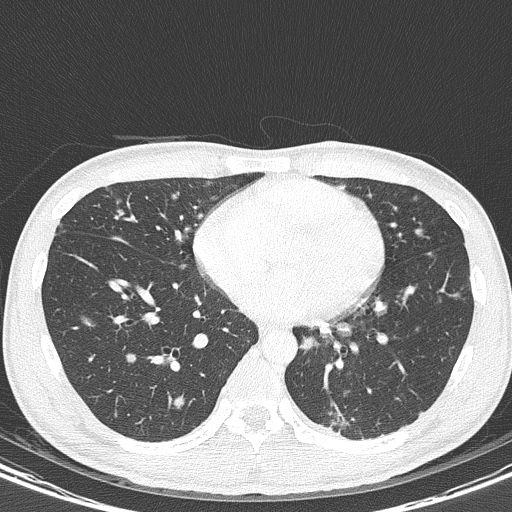 AIDS-related Kaposi sarcoma (Radiopaedia 85247-100811 Axial lung window 110).jpg