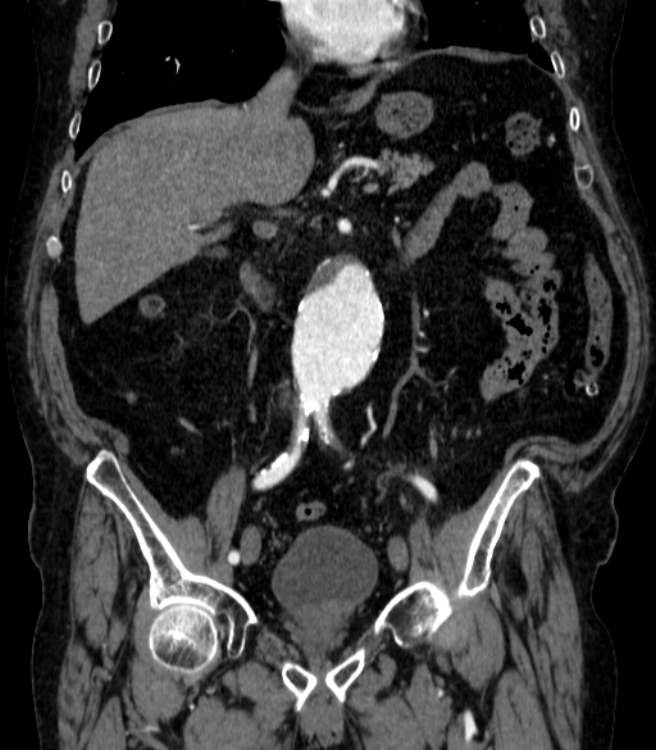 Abdominal aortic aneurysm (Radiopaedia 25855-26001 Coronal C+ arterial phase 27).jpg