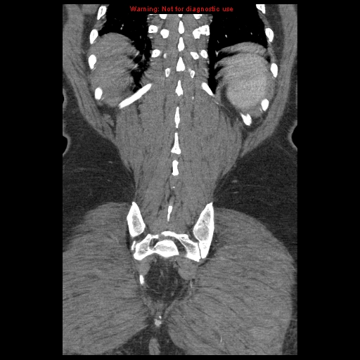 Abdominal aortic aneurysm (Radiopaedia 8190-9038 Coronal C+ arterial phase 112).jpg