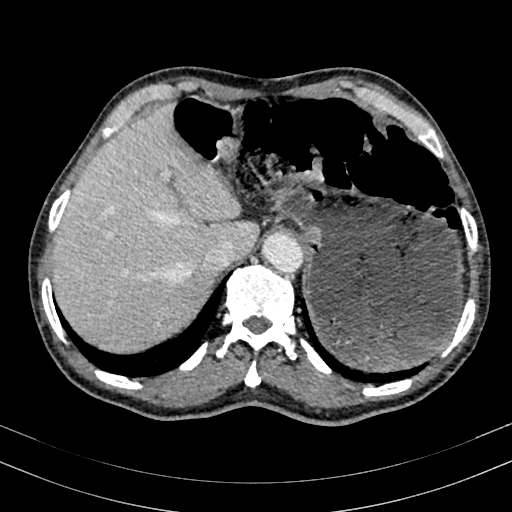 Abdominal aortic aneurysm (Radiopaedia 83581-98689 Axial C+ portal venous phase 20).jpg