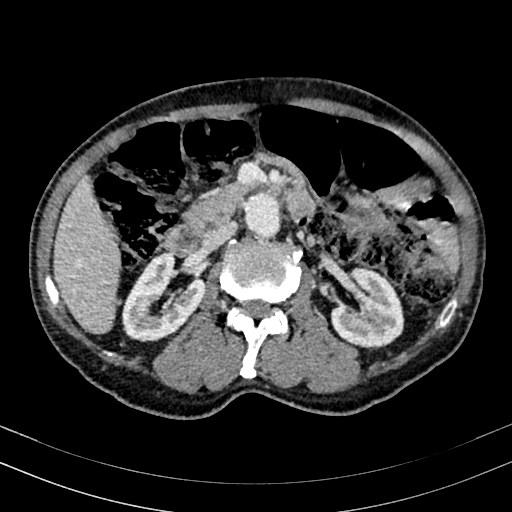 Abdominal aortic aneurysm (Radiopaedia 83581-98689 Axial C+ portal venous phase 48).jpg